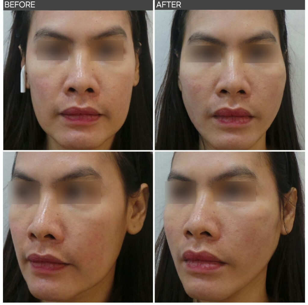 실리프팅 전후사진 정면 및 45도 사선 비교, 하부 볼에 몰려 있던 연부조직을 끌어올려 옆볼 볼륨과 얼굴선 균형이 개선된 PDO 코그실 시술 결과