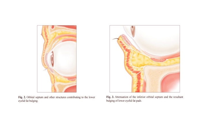 정상적인 눈밑과 돌출된 눈밑지방 비교 그림, 눈밑 지지 구조 변화에 따른 지방 돌출 차이를 보여주는 도해