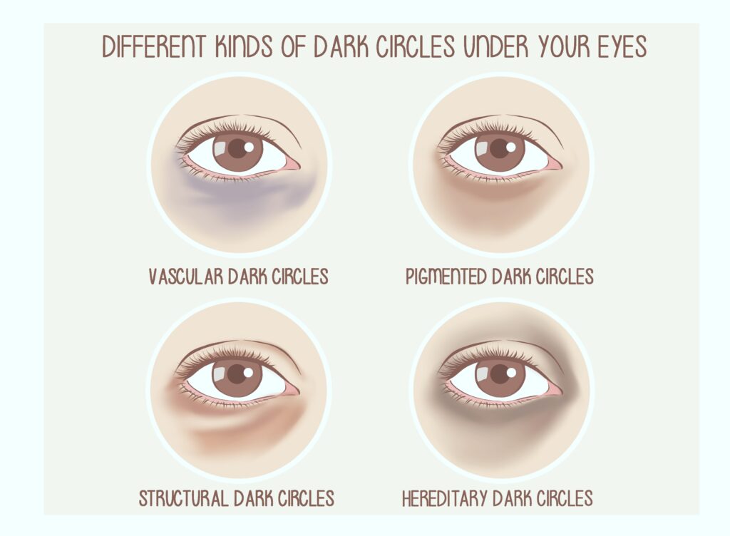 다양한 다크서클 원인 설명 그림, 색소형·혈관형·구조적 꺼짐형 다크서클의 차이를 나타낸 도식