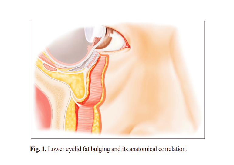 눈밑지방 돌출 단면 그림, 노화로 약해진 눈밑 지지 구조로 안와 지방이 전방 돌출되는 해부학적 구조