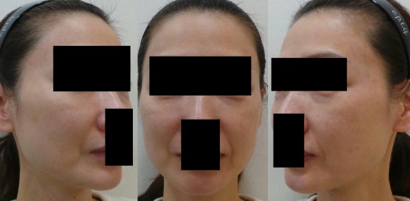 눈밑필러 전후사진, 시술 후 2년 이상 경과한 상태로 다크서클과 눈밑 꺼짐 개선 효과가 유지된 사례