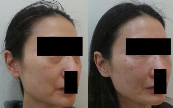 눈밑필러 전후사진 측면, 눈밑 꺼짐과 앞광대 라인을 소량 필러로 부드럽게 연결한 결과