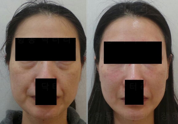 눈밑필러 전후사진 정면, 다크서클과 눈밑 꺼짐을 소량 필러로 자연스럽게 개선한 사례
