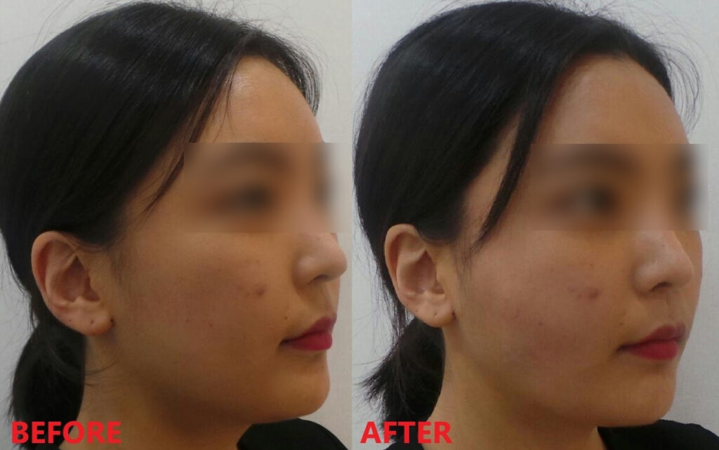 실리프팅 전후사진 45도 대각선 비교, 하관 연부조직 이동으로 브이라인 윤곽과 턱선 라인이 또렷해지고, 옆볼 꺼짐이 개선된 모습