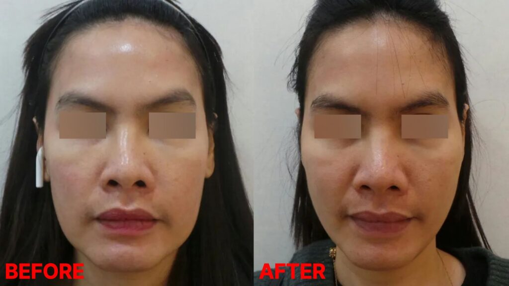 실리프팅 전후사진, 시술 2주 후 붓기가 가라앉은 상태에서 PDO 코그실로 처진 볼 아래 살을 이동시켜 옆볼 꺼짐과 얼굴선이 자연스럽게 개선된 모습.