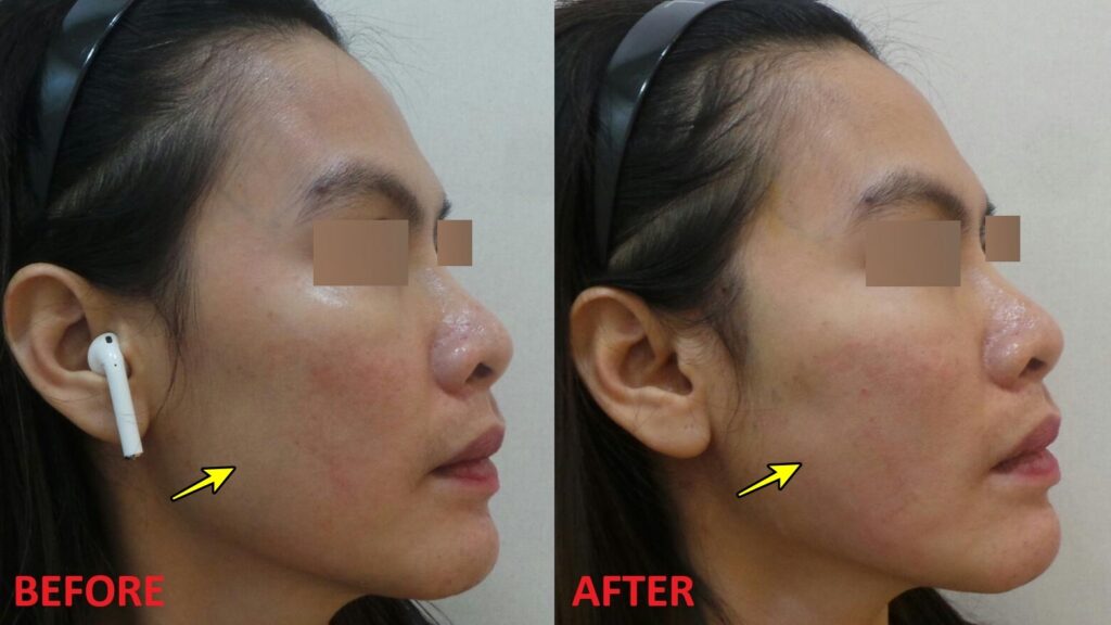 실리프팅 전후사진 우측면 비교, 처진 볼 아래 살을 위로 이동시켜 꺼진 옆볼이 자연스럽게 채워진 변화를 확인할 수 있는 모습.