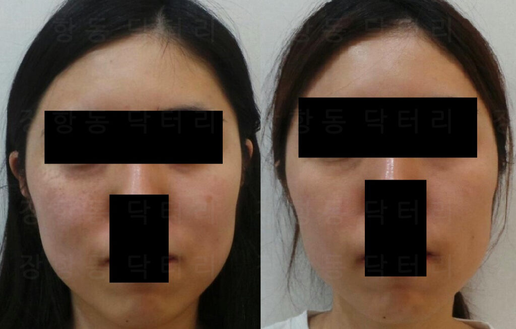 오타모반 치료 전후 정면 비교, 755nm 파장 레이저 적용 후 색소 개선