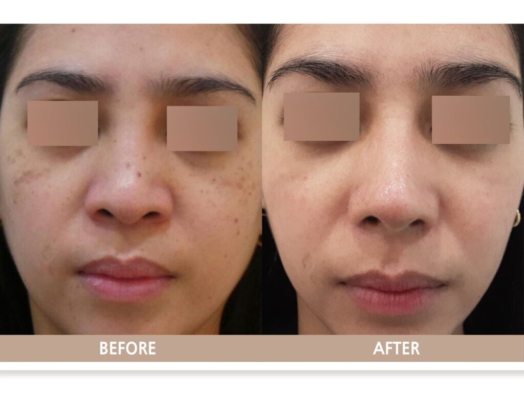 일산 리뉴앤영의원 후천성오타모반 ABNOM 정면 전후사진, 양측 광대 피코슈어 레이저 치료 변화