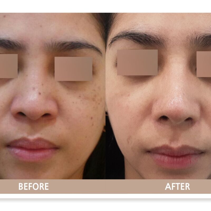 일산 리뉴앤영의원 후천성오타모반 ABNOM 정면 전후사진, 양측 광대 피코슈어 레이저 치료 변화