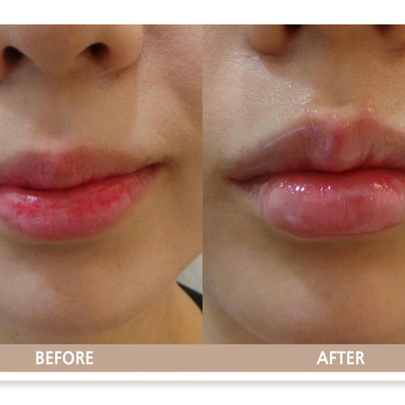 자연스러운 볼륨과 입꼬리 개선이 확인되는 입술필러 전후사진
