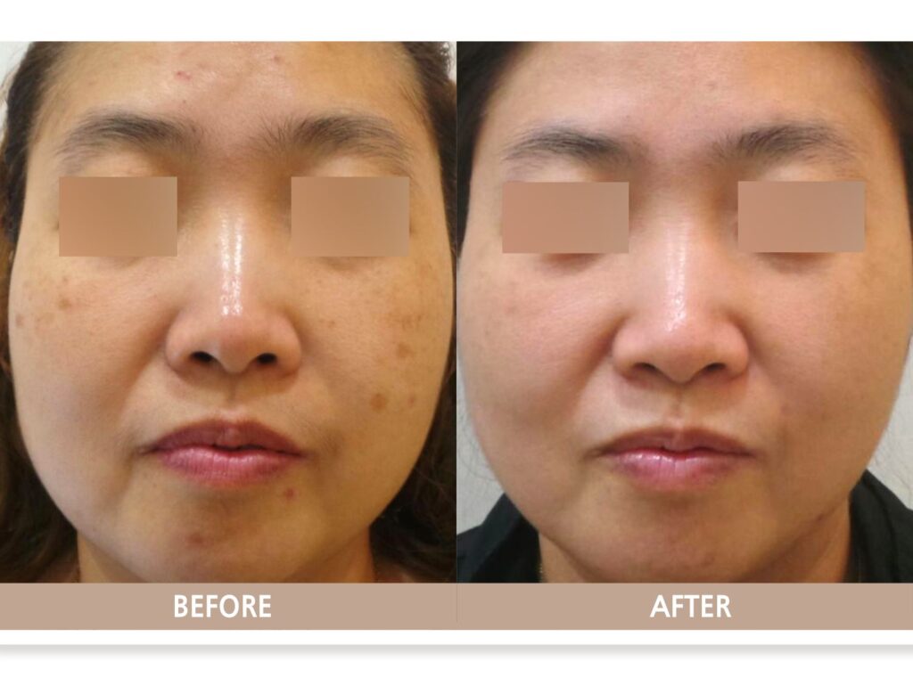 기미, 검버섯(일광 흑자) 복합 병변의 케이스, 기미 악화 없이 검버섯(일광 흑자)만 깔끔하게 제거됨.