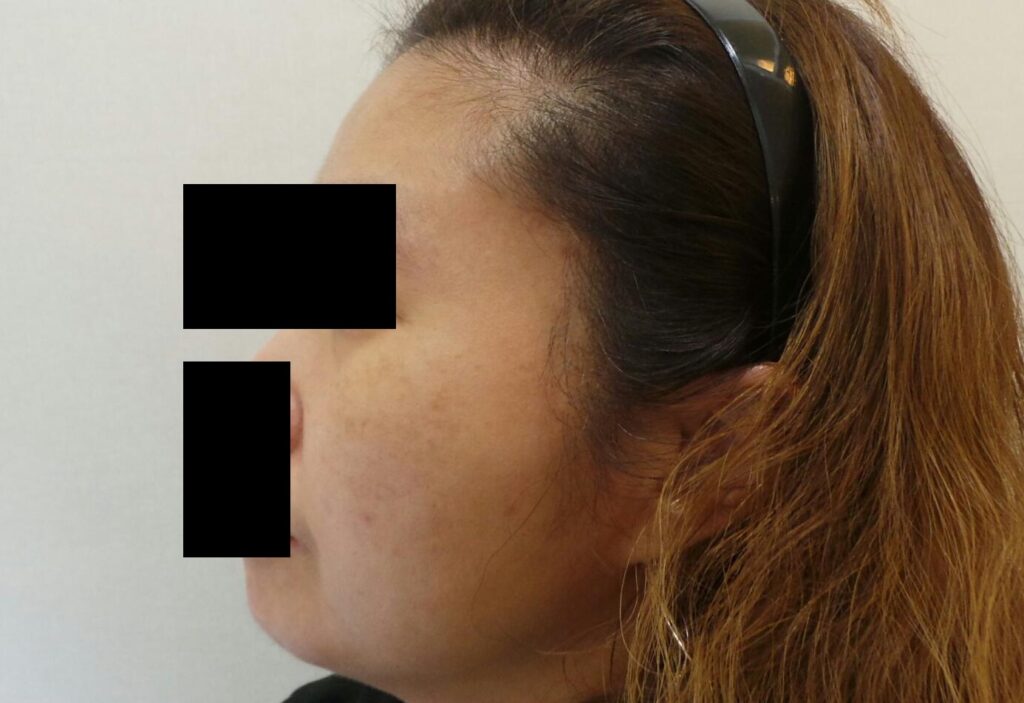 일산 리뉴앤영 레이저 시술 후 기미 악화 없이 흑자 병변만 개선된 모습.