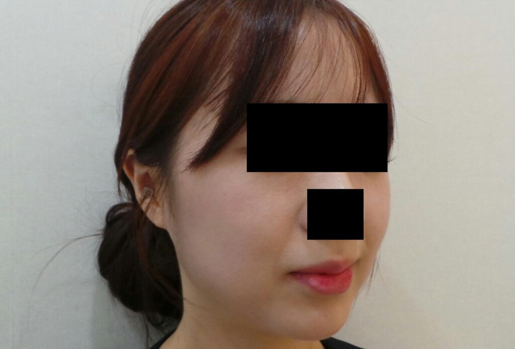 입술필러 전 사진. 흐릿한 입술 라인과 주름진 아랫입술.