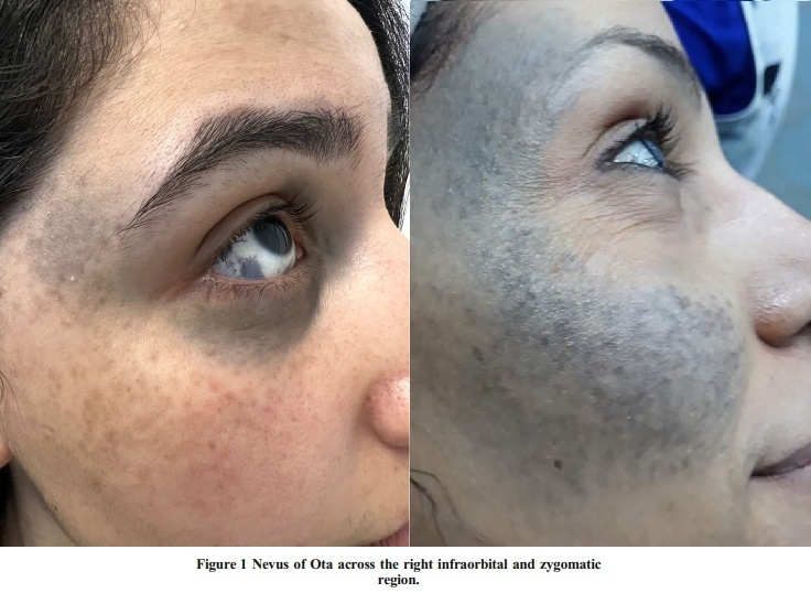 얼굴에 회청색~짙은 갈색으로 나타나는 오타모반 병변을 보여주는 사진.