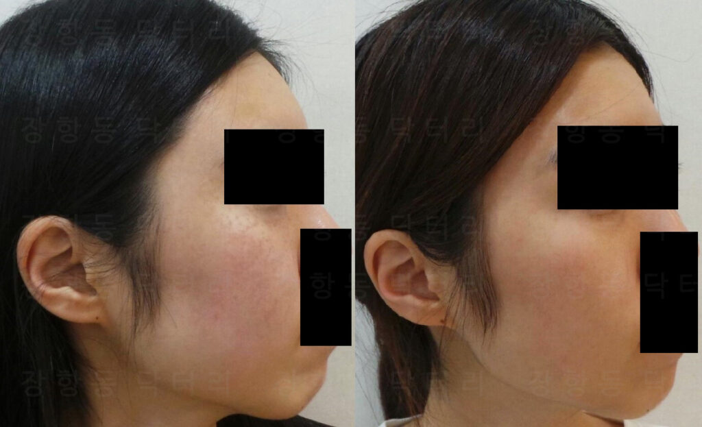 오타모반 치료 전후 측면 비교, 755nm 레이저 치료 후 피부톤 정돈