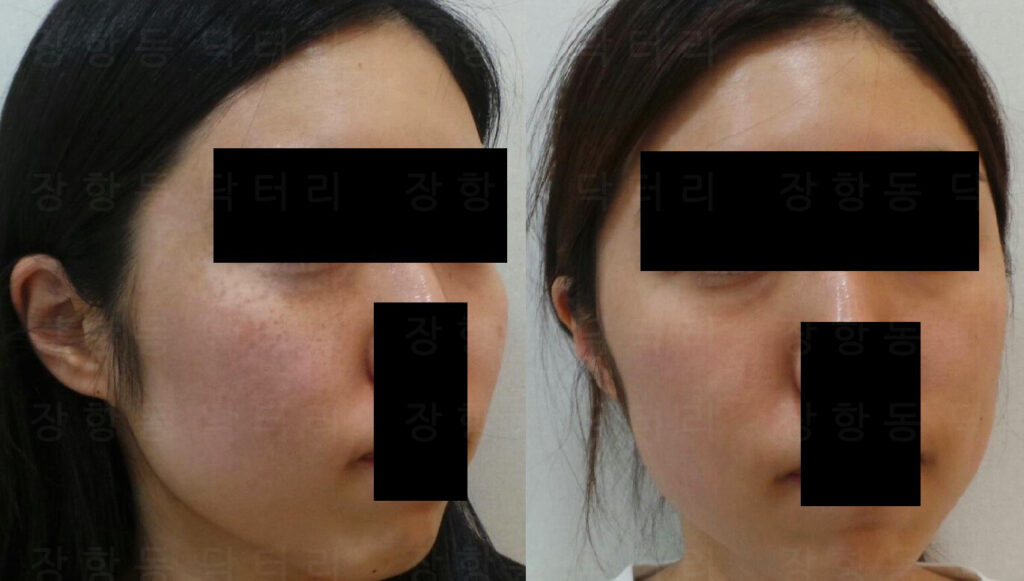 오타모반 레이저 치료 전후 대각선 각도 비교, 잔존 색소 변화 확인