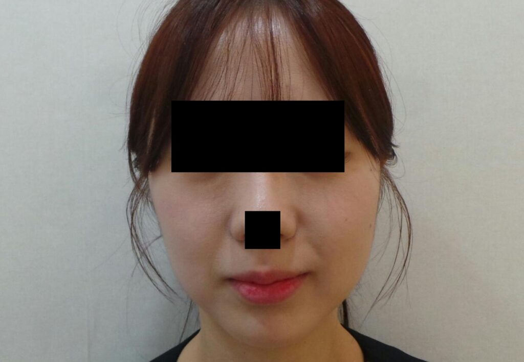 필러 시행 전 입술 모습. 볼륨이 부족하고 주름져있다.