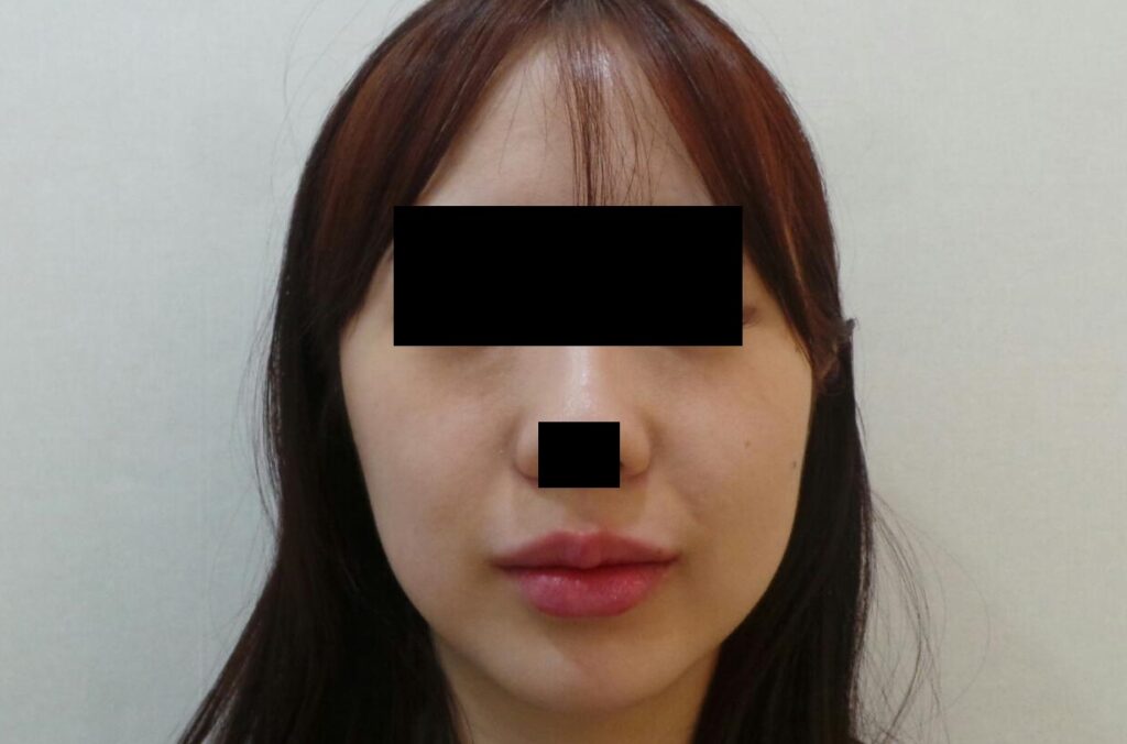 리뉴앤영 일산 입술필러 후 사진. 자연스런 주름과 볼륨 개선.