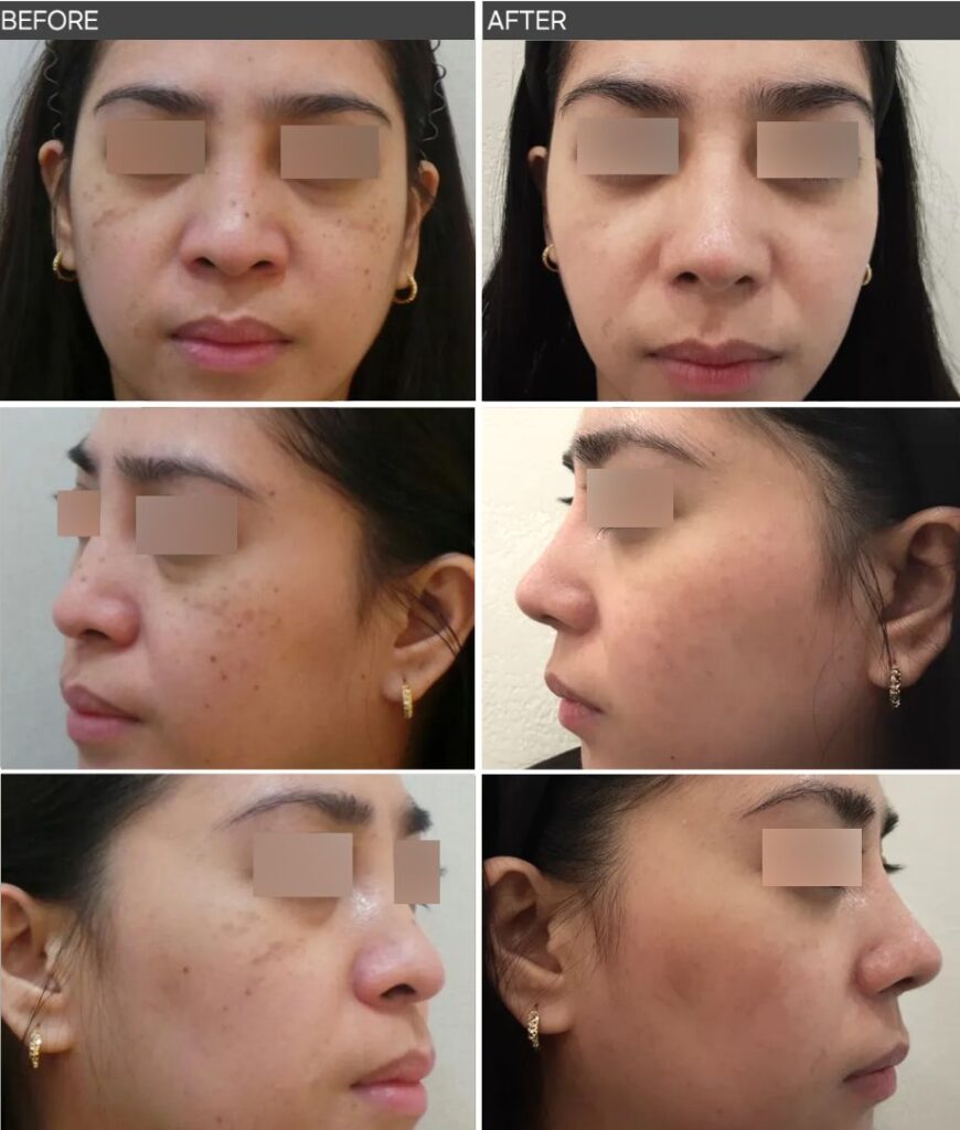 일산 리뉴앤영의원 후천성오타모반 전후사진, 후천성 양측성 오타양 모반 ABNOM 피코슈어(PicoSure) 레이저 치료 전과 후 비교