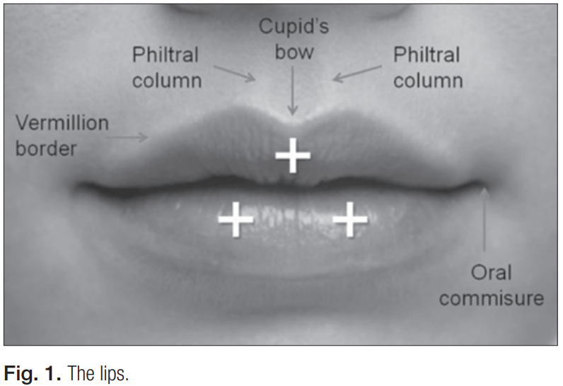 자연스러운 입술필러의 기준을 설명하는 사진.