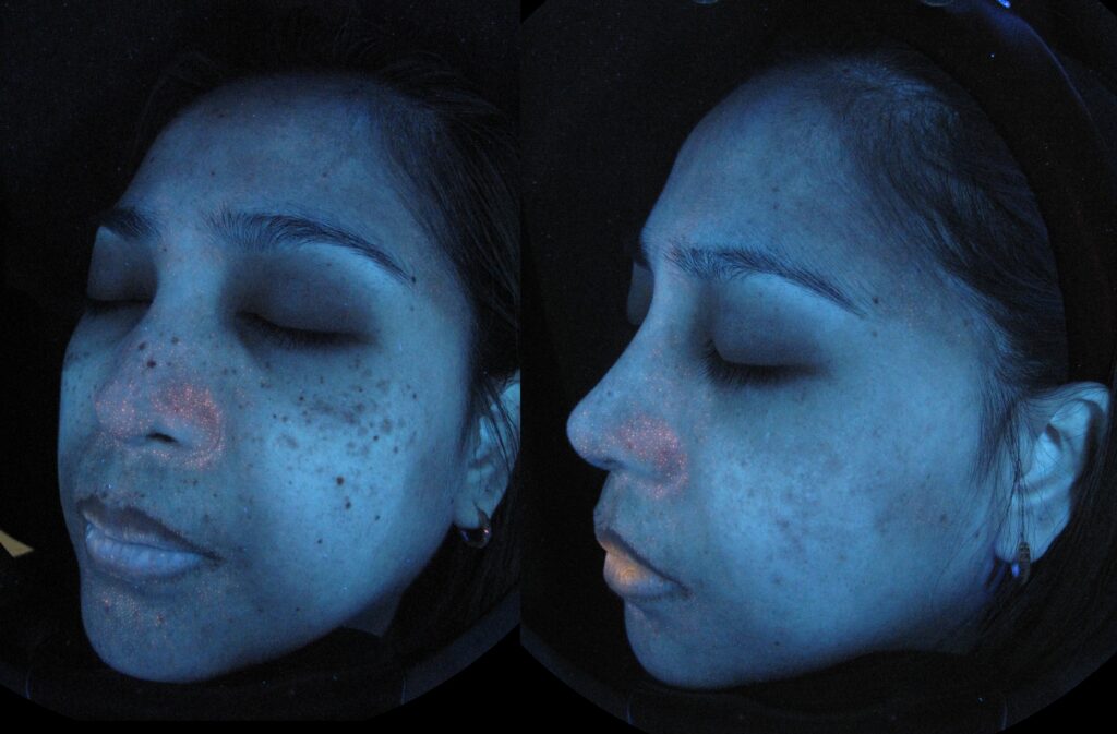 일산 리뉴앤영 의원 자외선 촬영 전후사진, 피코슈어 치료 후 후천성오타모반(ABNOM) 병변 소실 확인