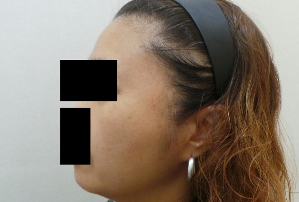 리뉴앤영 레이저 토닝을 병행하여 검버섯(일광 흑자) 병변 뿐만 아니라, 기미 역시 개선된 모습.