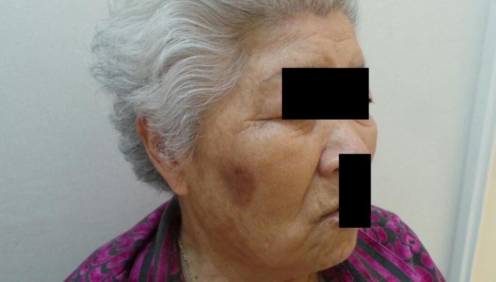 오래된 노인성 흑자를 회차별 레이저로 안전하게 개선한 모습