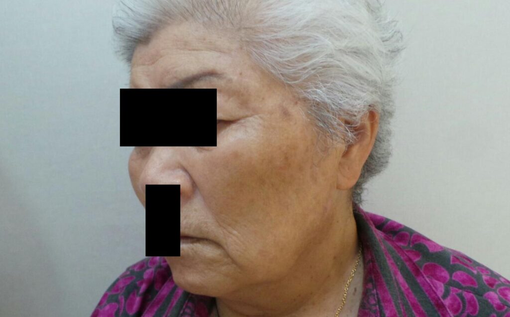 80 대 노인의 검버섯(노인성 흑자) 치료 후 사진.