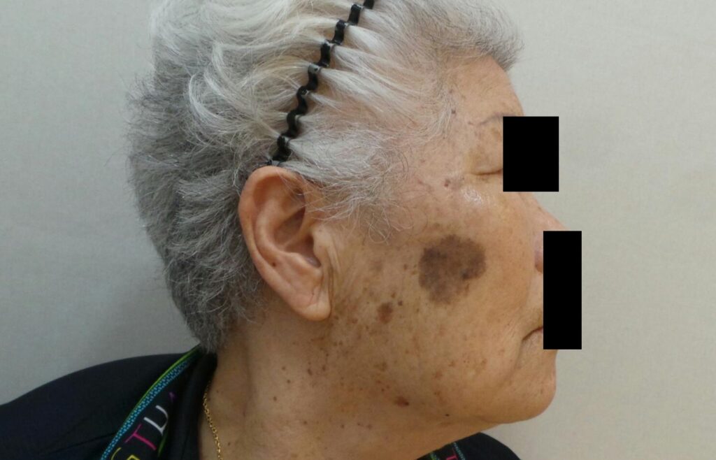 오래된 노인성 흑자(검버섯)의 치료 전 모습.