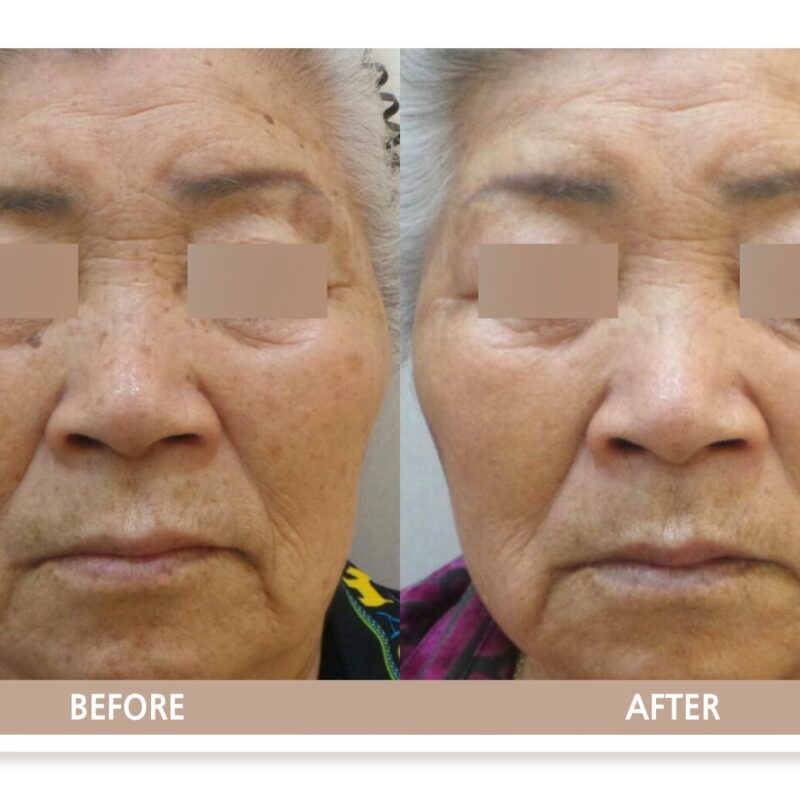 80대 노인성 흑자 전후사진, 얼굴 검버섯이 755nm 피코 레이저 치료 후 옅어진 모습