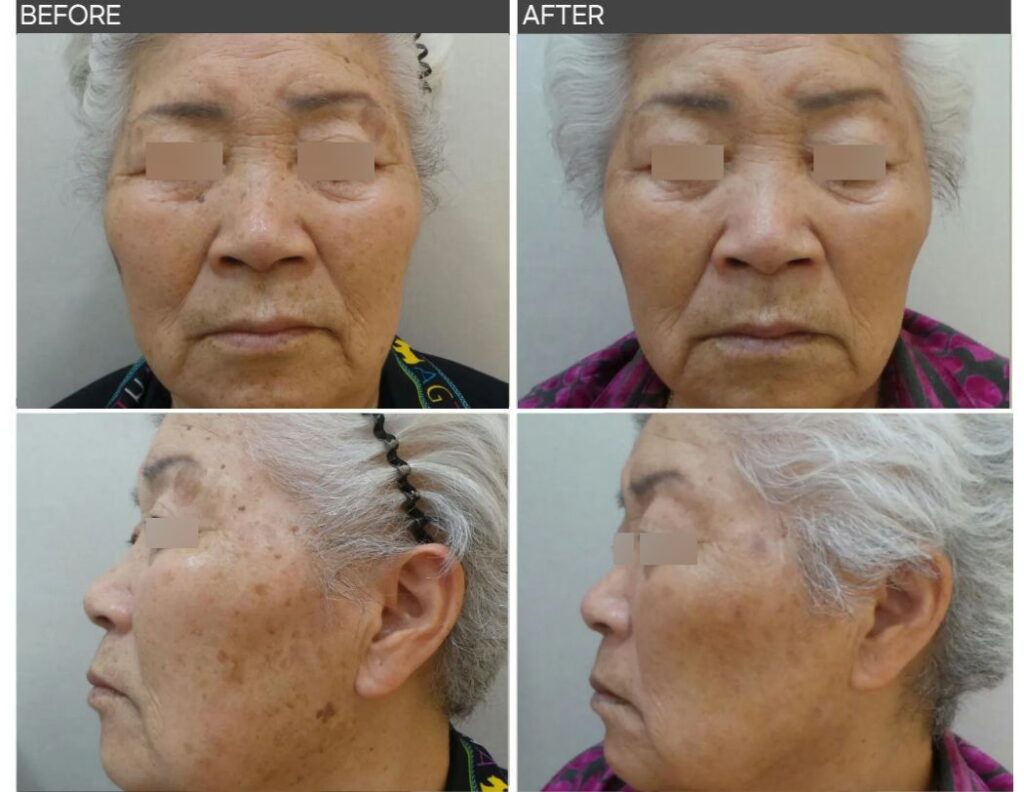 80대 노인성 흑자 전후사진, 얼굴 검버섯이 755nm 피코 레이저 치료 후 옅어진 모습