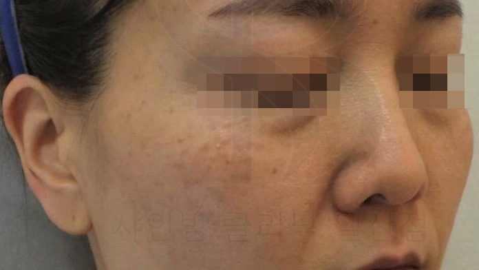 후천성 오타모반 치료 전후 사진 비교, 토닝만으로 충분할까요? - 리뉴앤영 | 일산 피부과