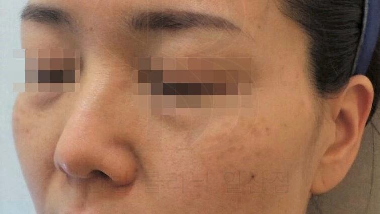 후천성 오타모반, 정확한 용어로 후천성 양측성 오타양 모반 색소 병변의 모습. 광대에 동글동글한 병변이 모여있다.