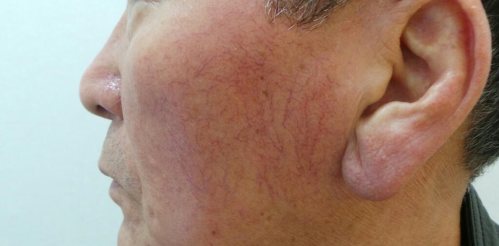 고양시 일산 얼굴 모세혈관 확장증 치료 전 사진 – 얼굴에 나뭇가지처럼 굵고 넓게 확장된 혈관이 관찰되는 상태