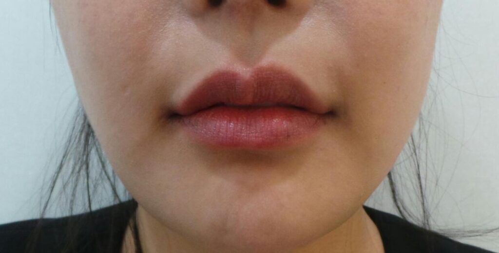 일산 입술필러 시술 후 2년 6개월 경과 사진, 개인 차이를 고려한 장기 경과 관찰 사례