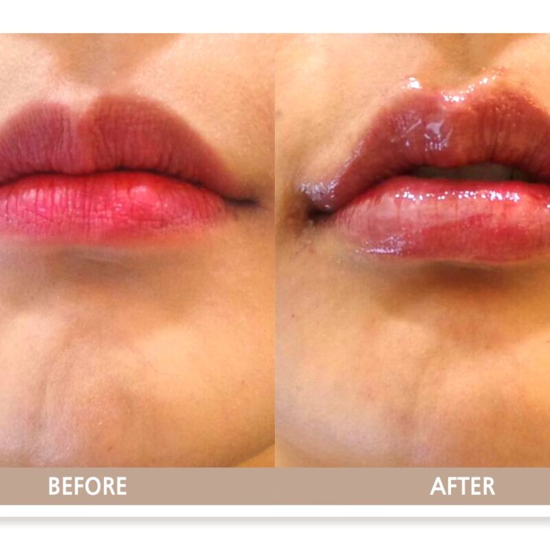 일산 입술필러 전후사진 정면 비교, 자연스러운 입술 볼륨 변화