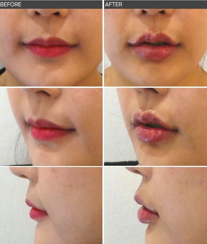 입술필러 전후사진 전면, 대각선 각도, 측면 비교, 과도한 돌출 없이 입술 볼륨과 입꼬리 각도가 자연스럽게 조화된 모습