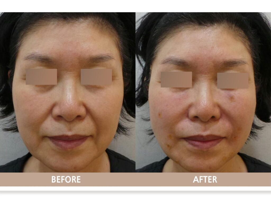 일산 실루엣 소프트 실리프팅 전후사진 정면 비교