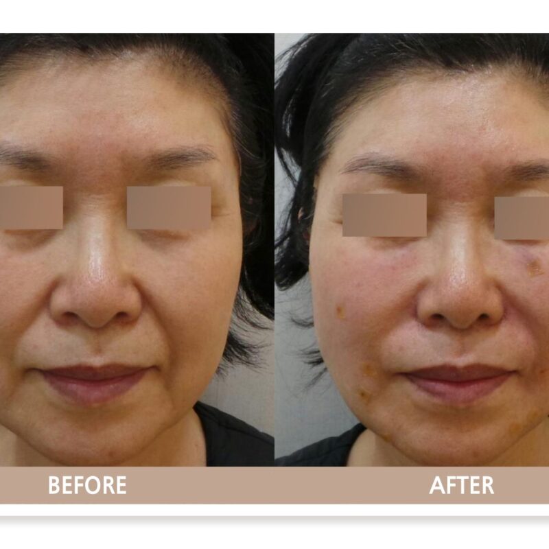 일산 실루엣 소프트 실리프팅 전후사진 정면 비교