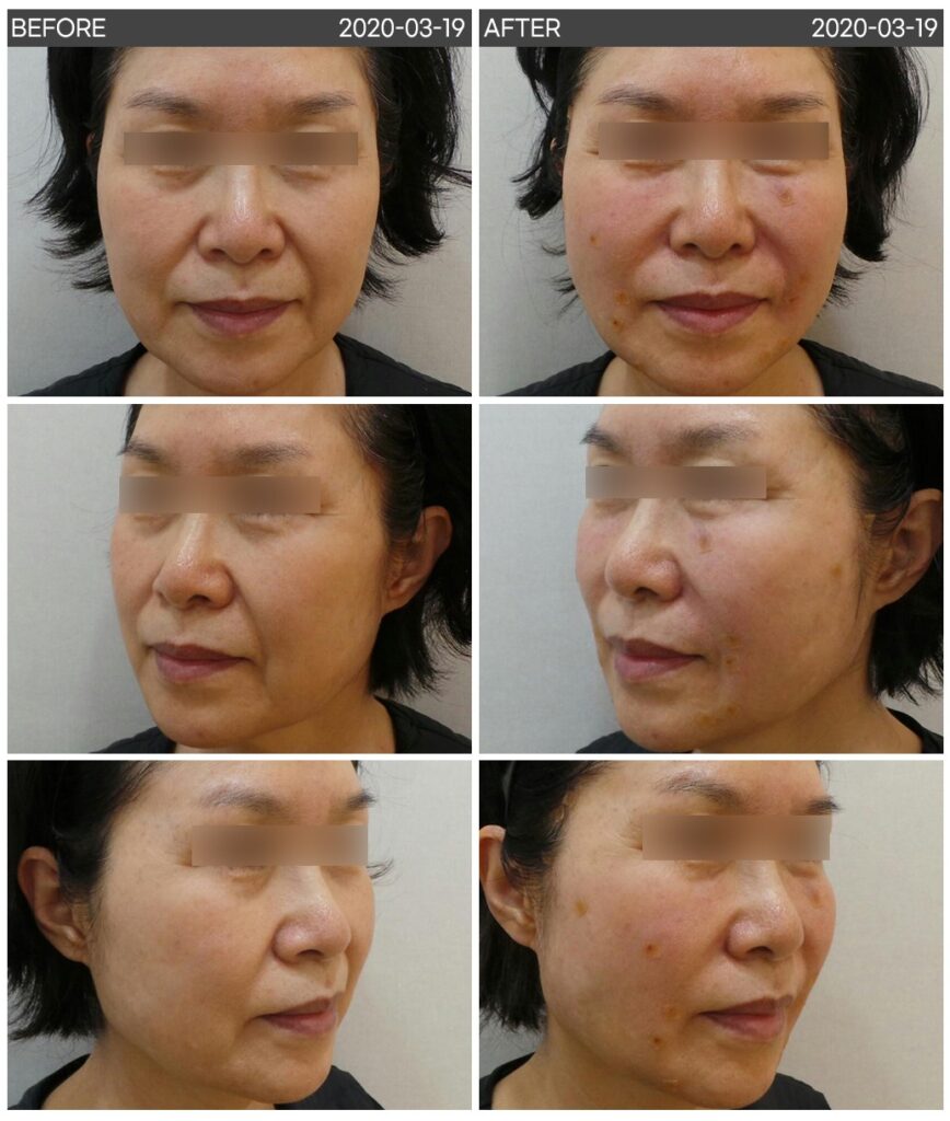 일산 실루엣 소프트 실리프팅 전후사진 정면·좌측면·우측면 비교