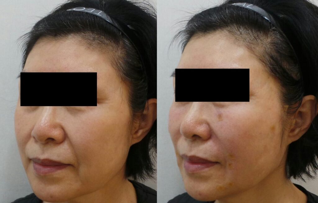 일산 실루엣 소프트 실리프팅 전후사진 좌측면 비교, 팔자 주름과 마리오네트 주름 부위가 자연스럽게 정리된 모습