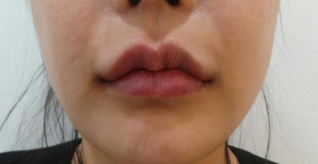 일산 입술필러 윗입술 비대칭 교정 후 사진, 좌우 균형을 고려해 자연스럽게 정돈된 모습