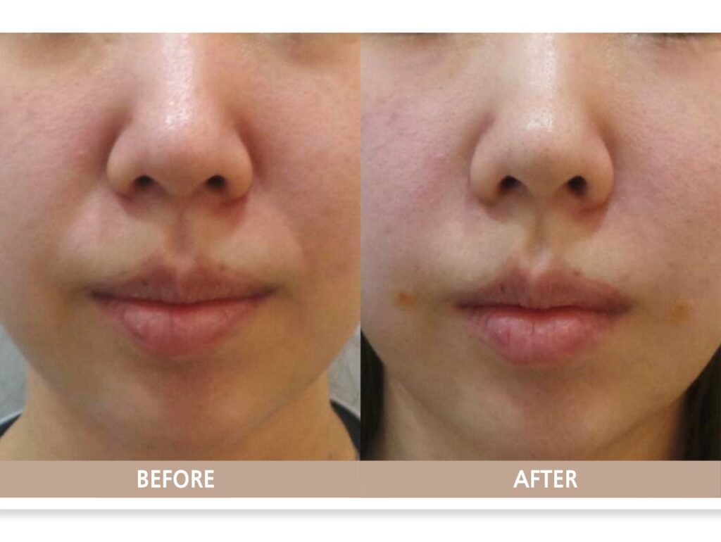 일산 리뉴앤영 의원 젊은 팔자 필러 전후사진, 소량 필러로 인상이 자연스럽게 개선된 모습