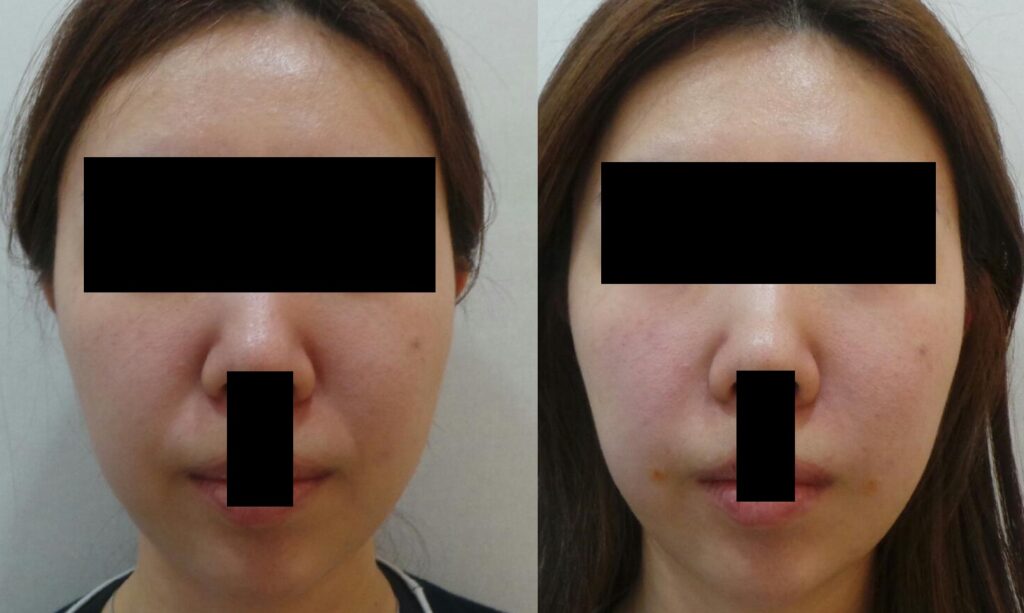 전후사진 정면, 소량 필러로 팔자주름과 입 돌출 인상이 자연스럽게 개선된 모습