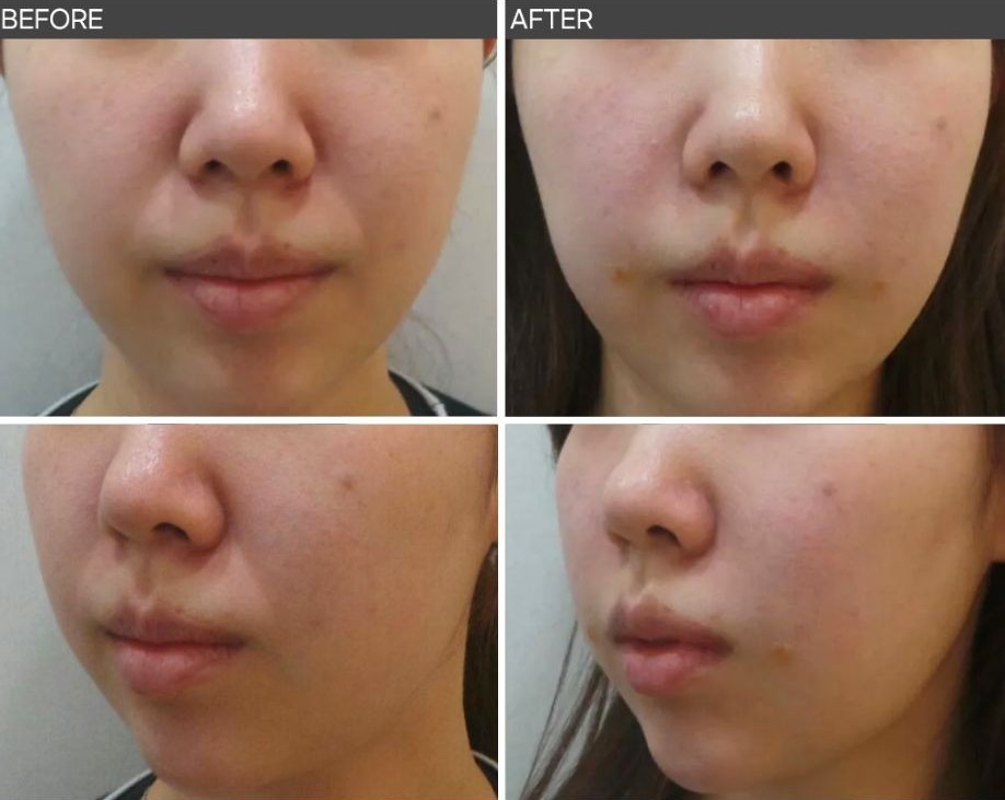 젊은 연령대의 팔자주름 전후사진, 정면과 측면 비교에서 인상이 자연스럽게 정돈된 변화