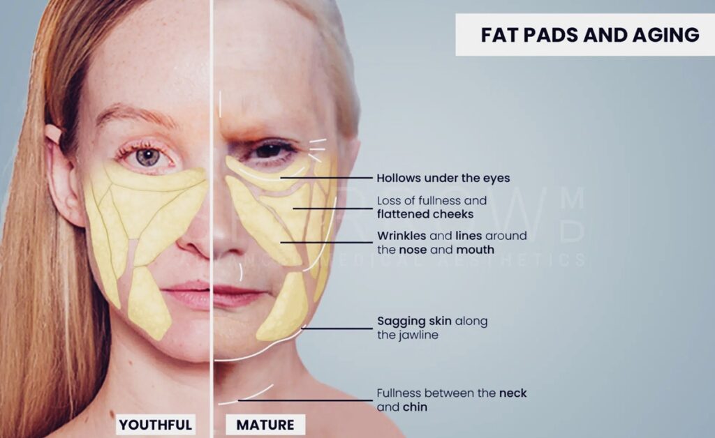 젊은 사람과 나이든 사람의 팔자 주름에서 나타나는 지방 분포 차이를 비교한 해부 구조 그림, 팔자 필러 기준이 달라야 하는 원인을 보여줌.