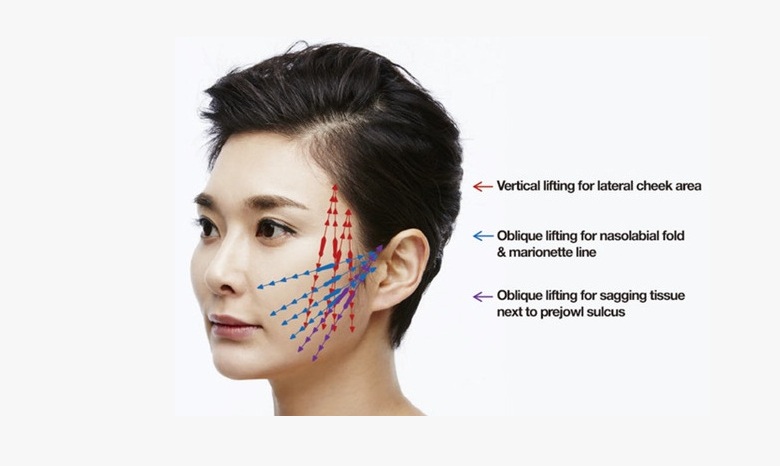 과도한 당김 없이 얼굴 구조에 맞춰 설계된 자연스러운 실리프팅 디자인 이미지