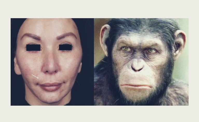 과도한 팔자 필러 주입으로 입가 볼륨이 부자연스럽게 보이는 얼굴 모습