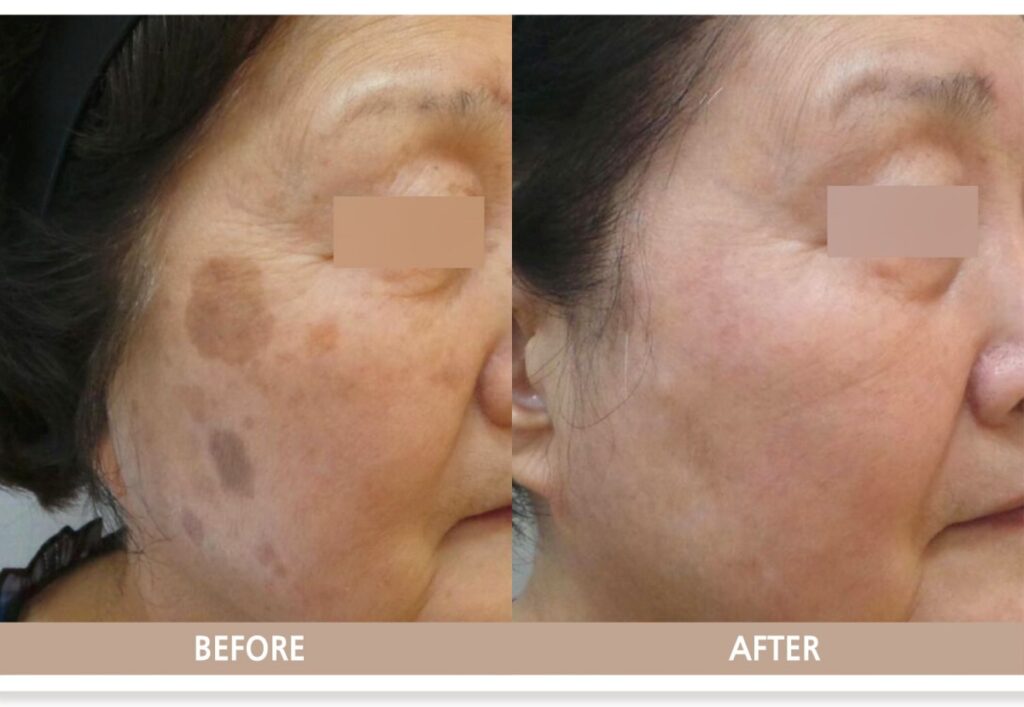 피부 상태를 정확히 분석한 치료 전후 비교 사진으로, 색소와 피부톤 변화가 일관되게 개선된 모습입니다. 좋은 결과 역시 피부과 선택 기준 중 하나입니다.