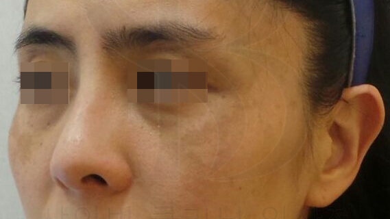 치료 전 광대의 기미(Melasma)